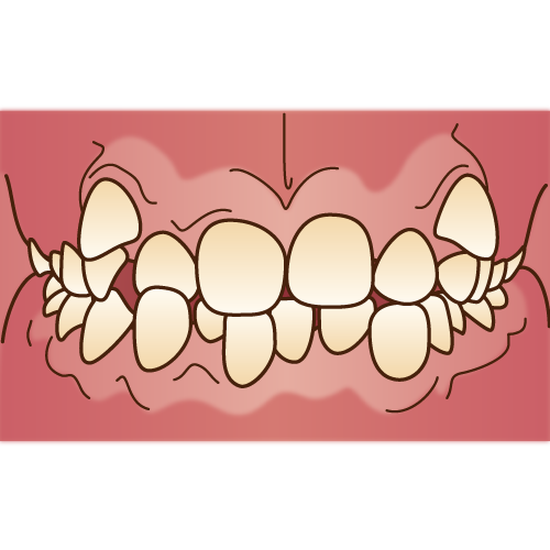 軽度の凹凸歯並びや八重歯